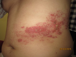 Shingles: red skin rash with blisters 25 March 2015