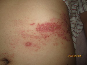 Shingles: red skin rash with blisters 25 March 2015