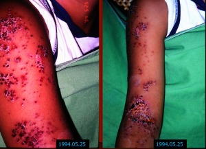 Scab forming on shingles rash 25 May 1994